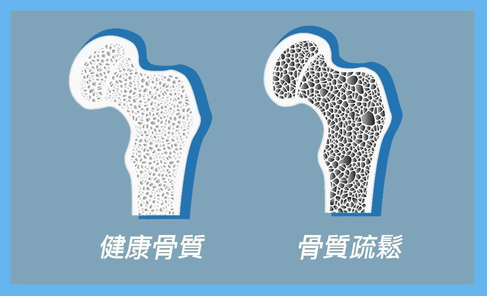 每日运动量对老年骨密度的积极影响，运动与骨骼健康的关联