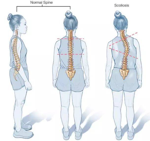 体态调整对预防脊柱问题的重要性研究