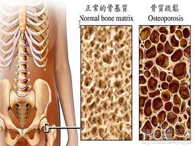 规律运动对骨质疏松的预防效果